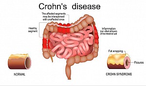 Bệnh CROHN