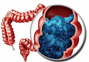 Hội chứng ruột kích thích (IBS)