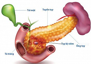 Hội chứng suy tụy ngoại tiết (PEI)