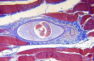 Bệnh giun xoắn (Trichinosis) là gì?